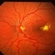 Capillary Hemongima, Coat's Response Capillary Hemongima, Coat's Response